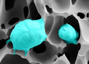 Prostatakrebszellen (grün) in einem hochporösen Cryogel mit gewebeähnlicher Elastizität. (Rasterelektronenmikroskop-Aufnahme: Bettina Göppert/KIT)
