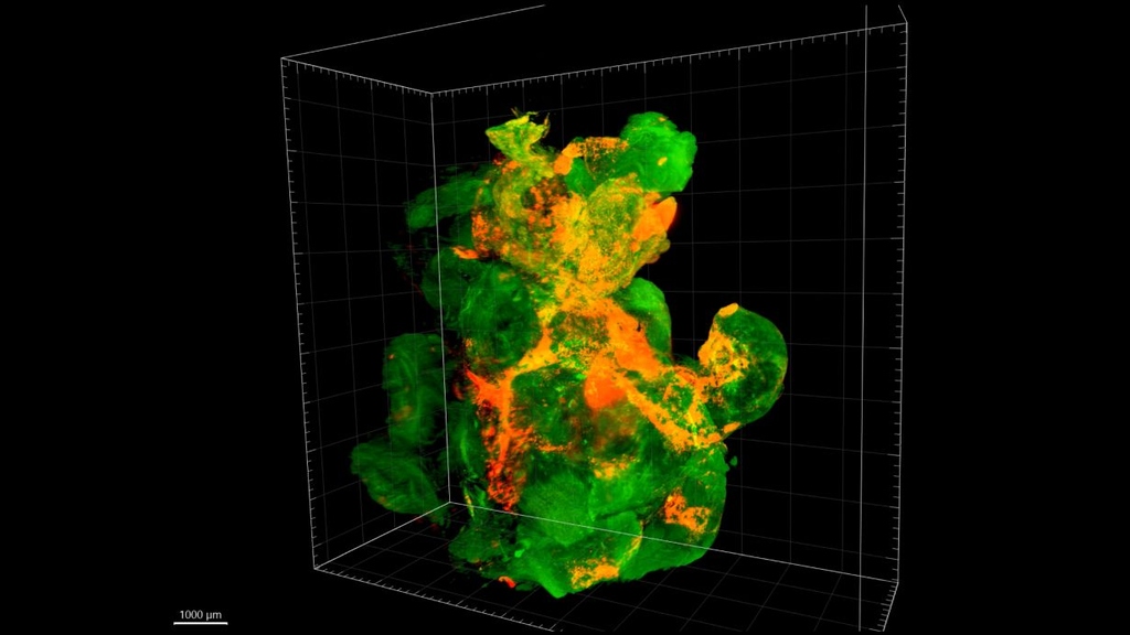 A tumor under the fluorescence microscope: the tissue of this pancreatic tumor in a mouse glows green, the nanoparticles orange. (Copyright: Myrto Ischyropoulou / Max Planck Institute for Multidisciplinary Sciences)