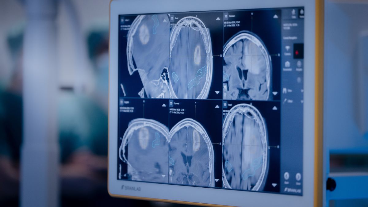 Federated Learning: Collaborative AI Development Across Hospital Boundaries