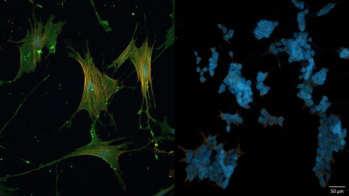 Pancreatic Cancer: Researchers Targetedly Reprogram the Tumor Microenvironment
