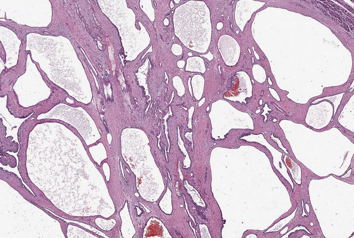 Mikroskopische Darstellung der Gewebestruktur eines serösen Zystadenoms in der Bauchspeicheldrüse