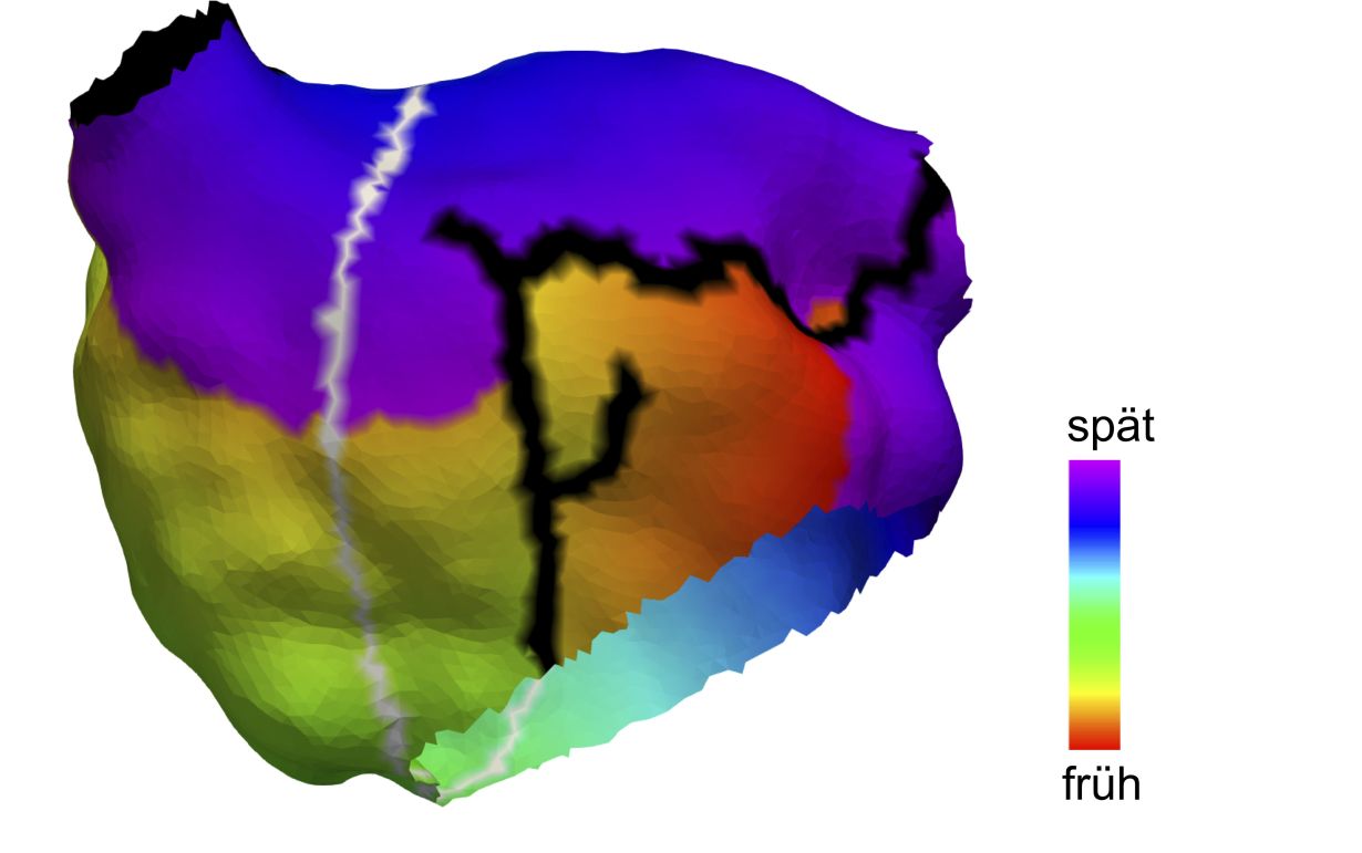 Anatomic model of the left cardiac atrium of a 70-year-old patient. (Figure: Axel Loewe, KIT).  ((spät = late; früh = early)) 